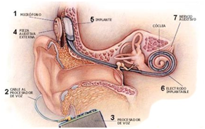 implantes oido medio