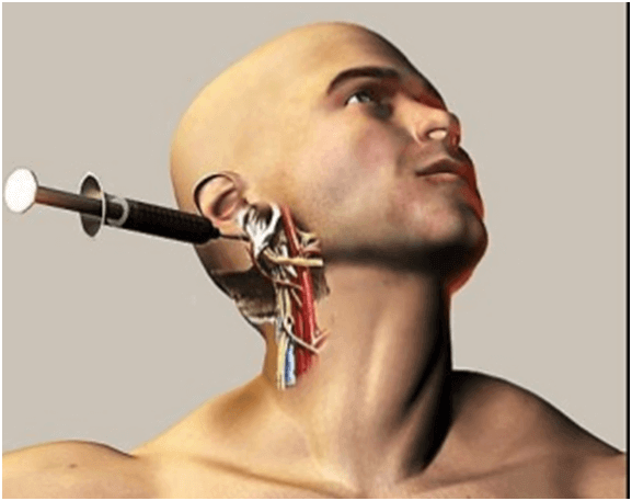 Анестезия тройничного нерва. Делают ли операцию на нервы. Делают ли операцию на нервы. Невротомия. Делают ли операцию на нервы.