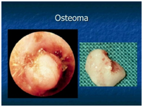 osteoma conducto