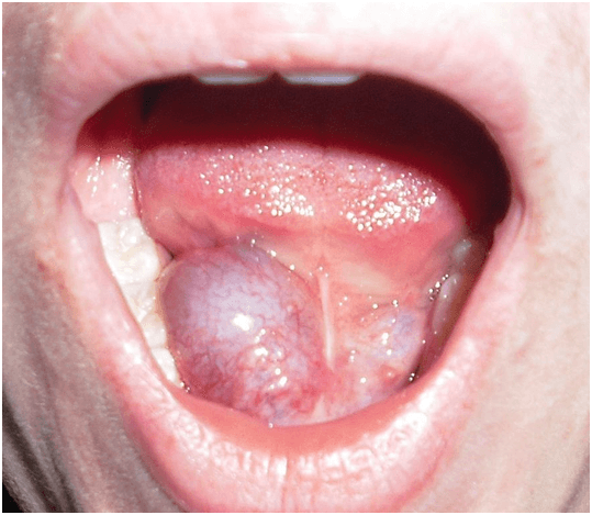 cirugia glandulas salivares menores